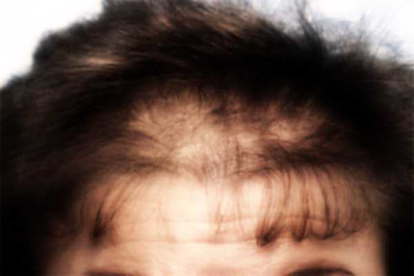 Trovata la cura per la calvizie? Due sperimentazioni ridanno speranza ai calvi