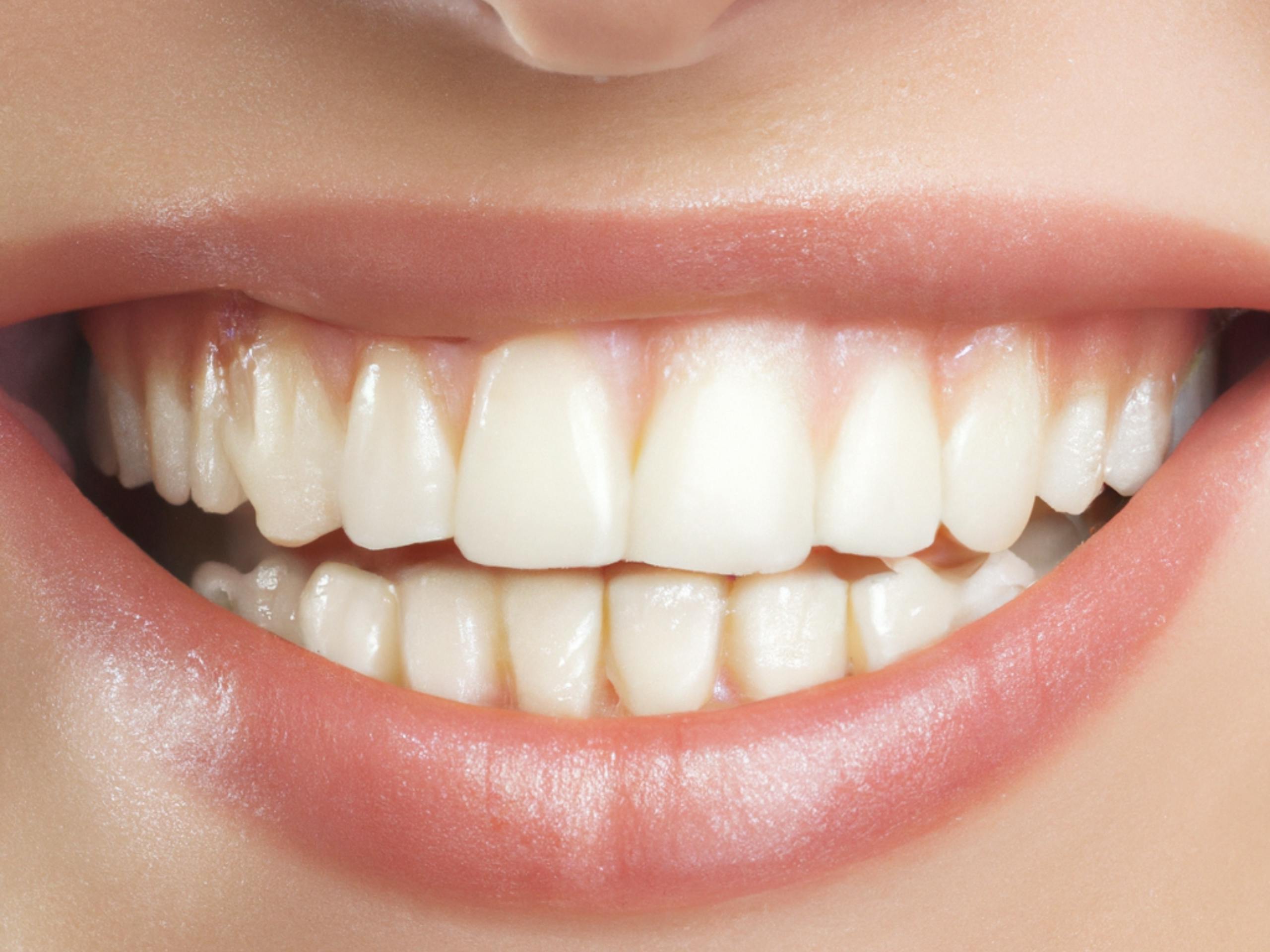 Sorriso naturale e perfetto? È possibile con l’implantologia dentale!